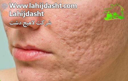 آب برنج برای جوش صورت